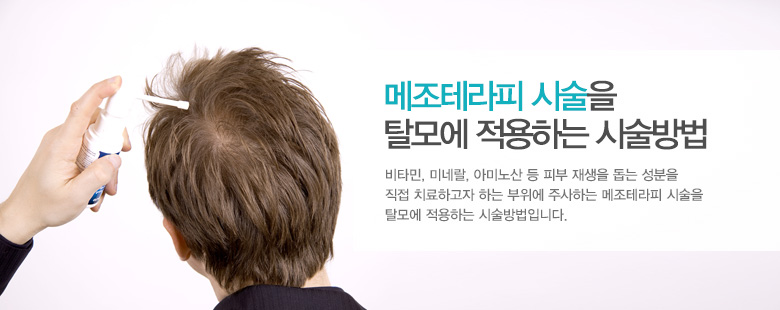 메조테라피 시술을 탈모에 적용하는 시술방법