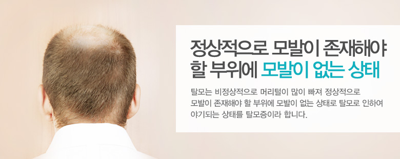 규칙적인 생활인 중요한 탈모의 치료